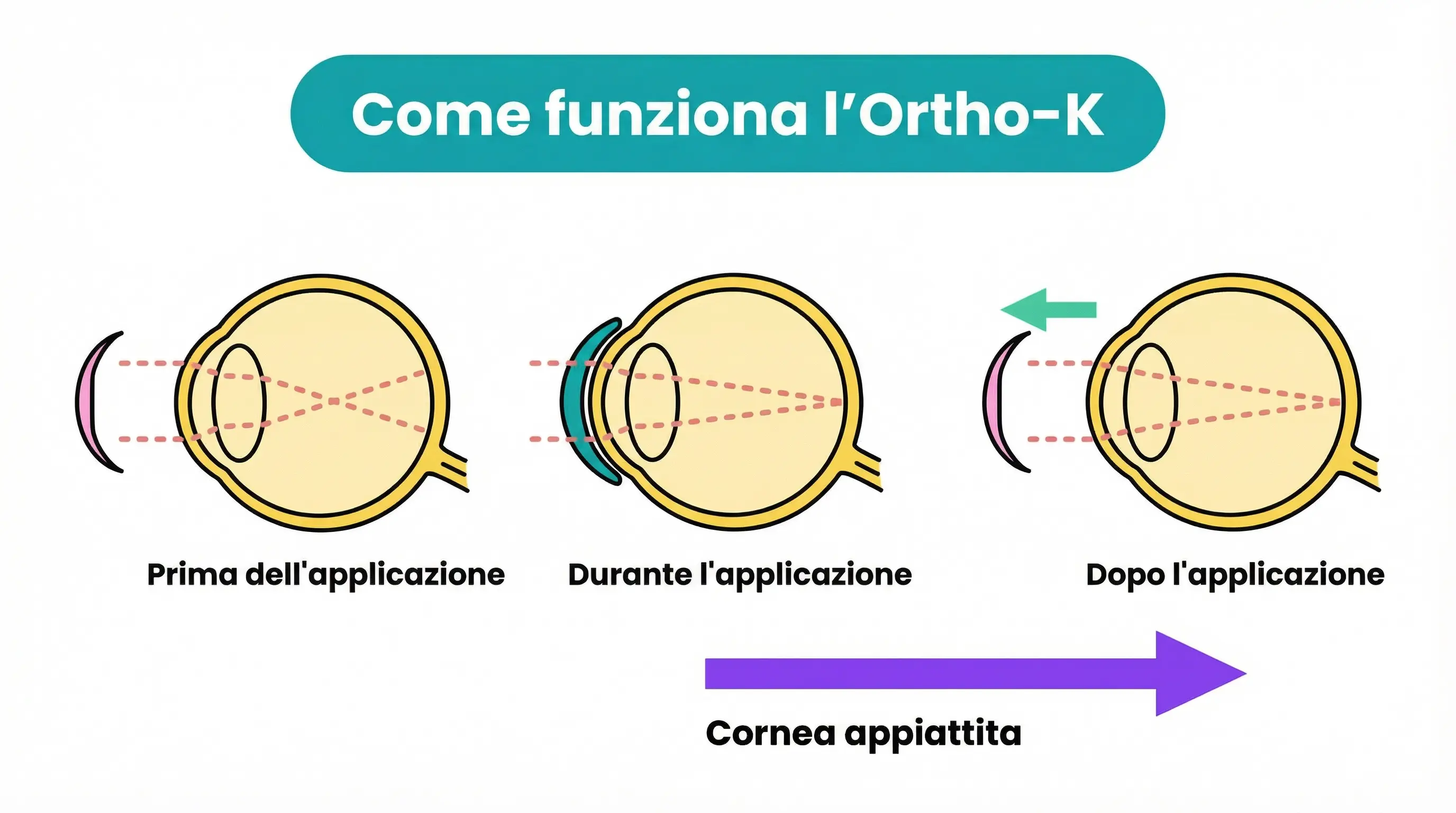 Ortho-K: Prima dell'applicazione · Durante l'applicazione · Dopo l'applicazione · Cornea appiattita